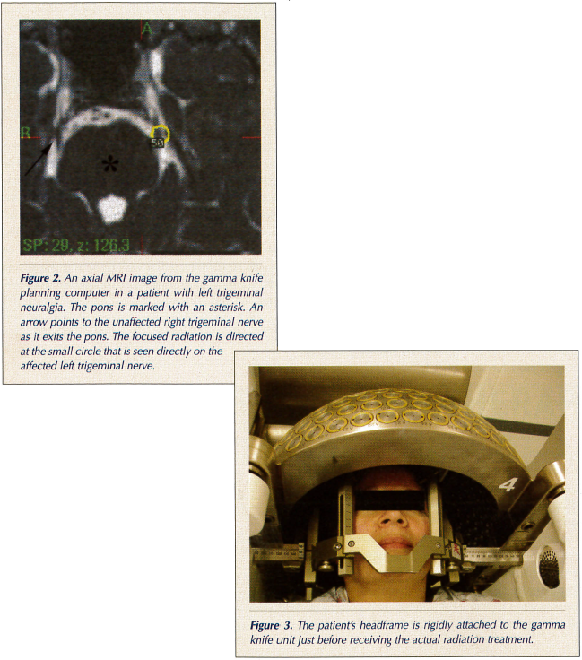 Gamma Knife Radiosurgery for Intractable Trigeminal Neuralgia in the